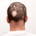 Naturheilkundliche Behandlung des kreisrunden Haarausfalls (Alopezia areata)