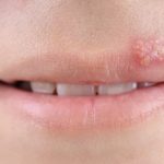 Naturheilkundliche Behandlung von Herpes-simplex-Infektionen